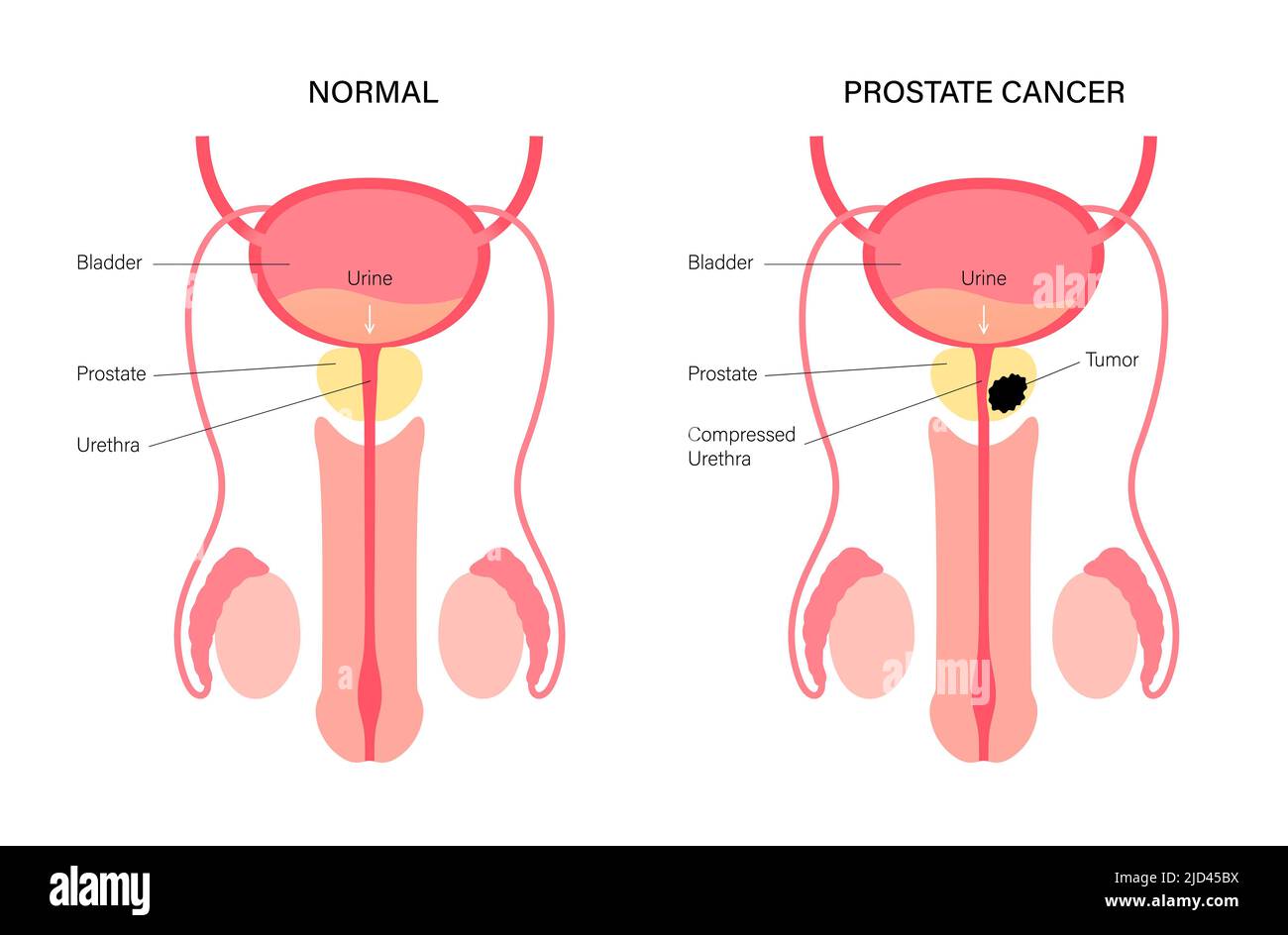 Prostate Cancer Backround Prostate cancer, illustration Stock Photo - Alamy