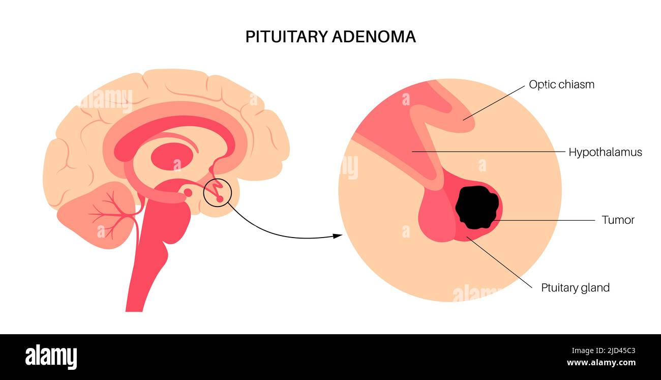 Pituitary adenoma cancer, illustration Stock Photo