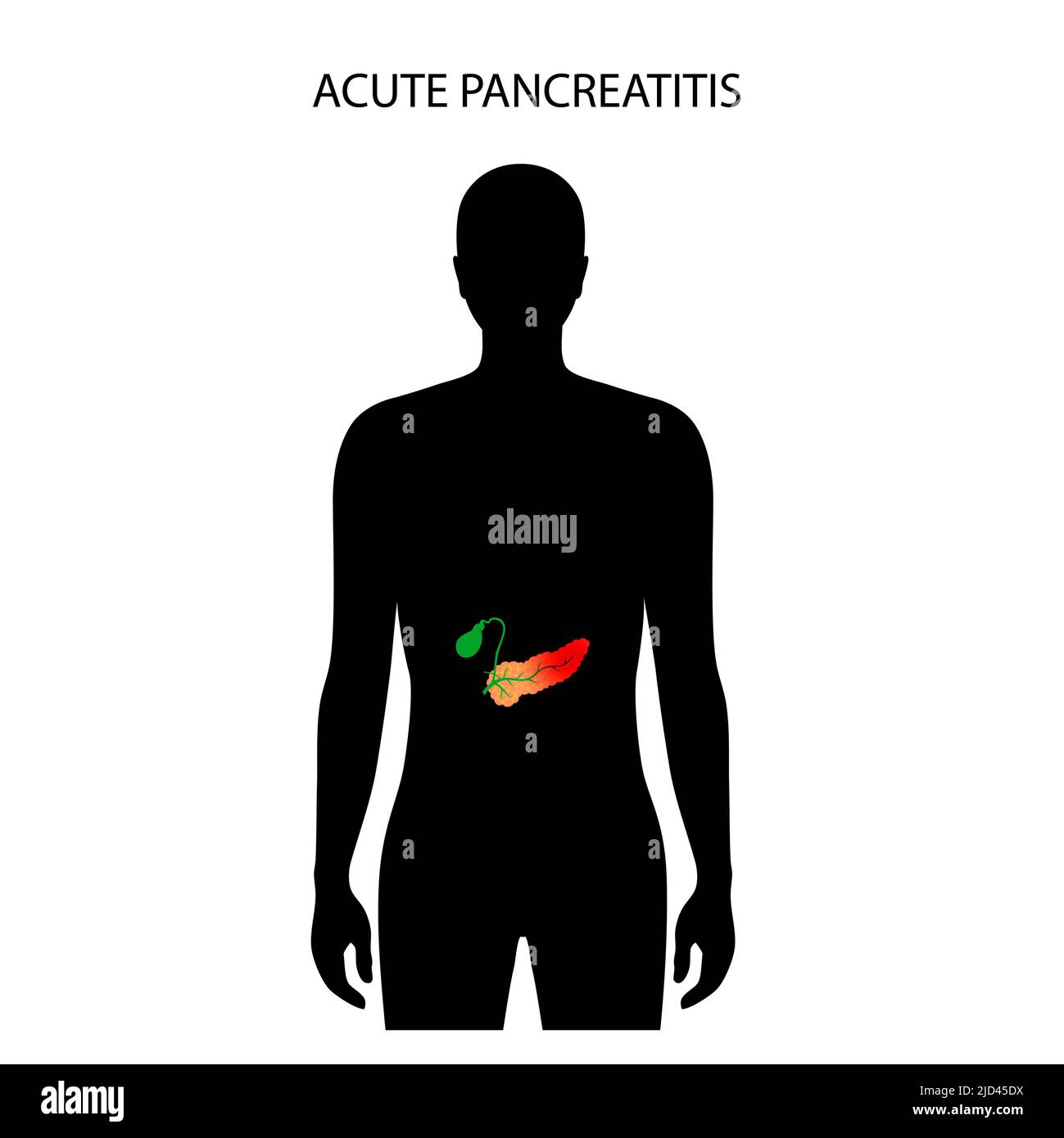 Acute pancreatitis, illustration Stock Photo Alamy