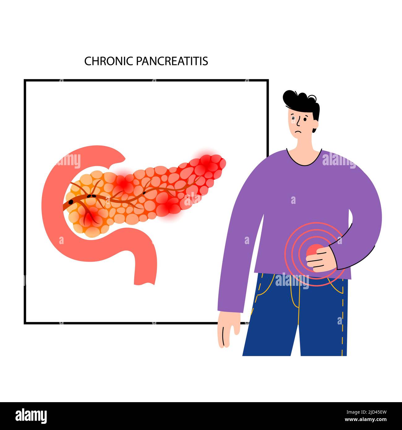 Chronic pancreatitis, illustration Stock Photo Alamy