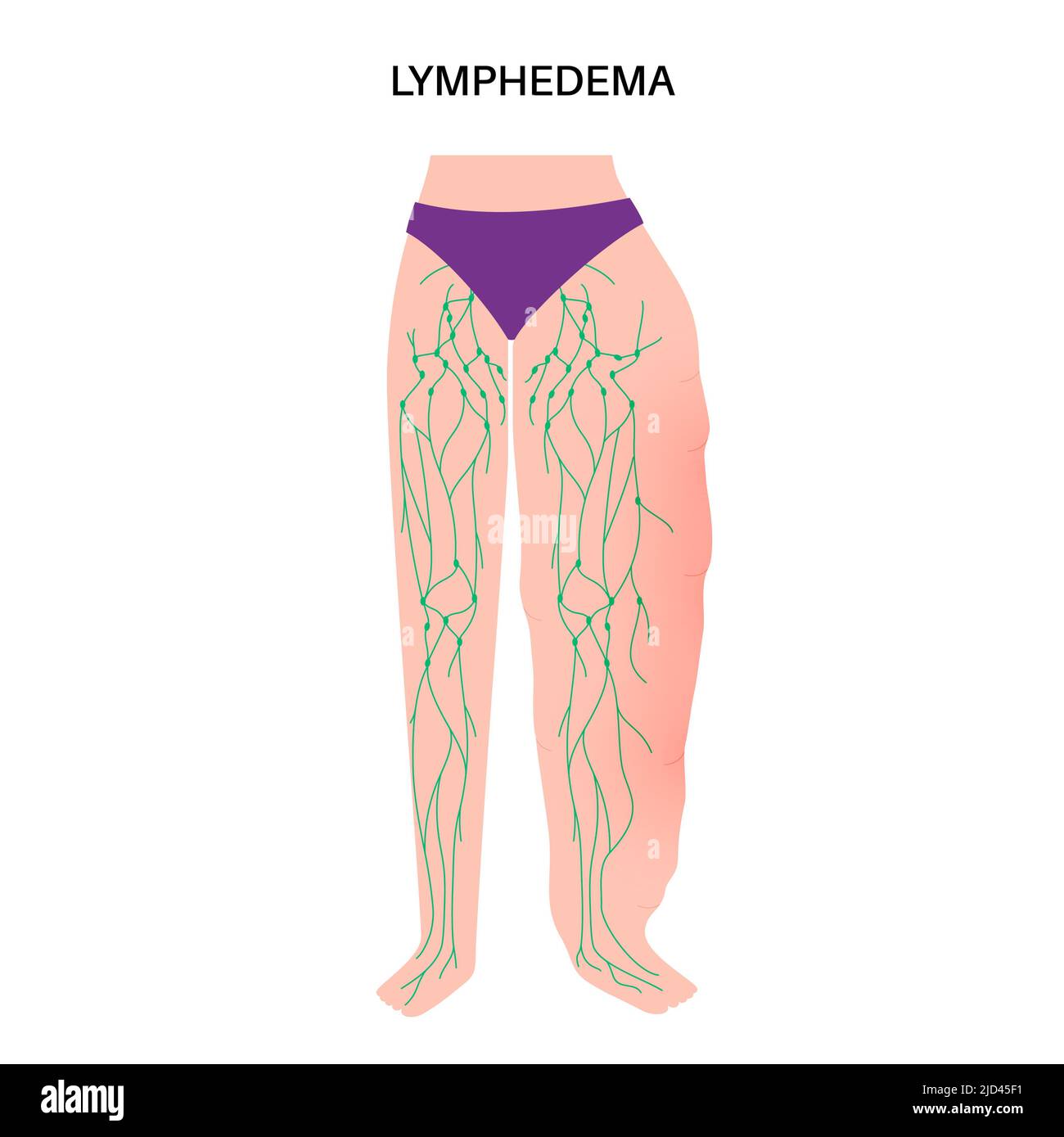 Lymphoedema leg swelling, illustration Stock Photo - Alamy