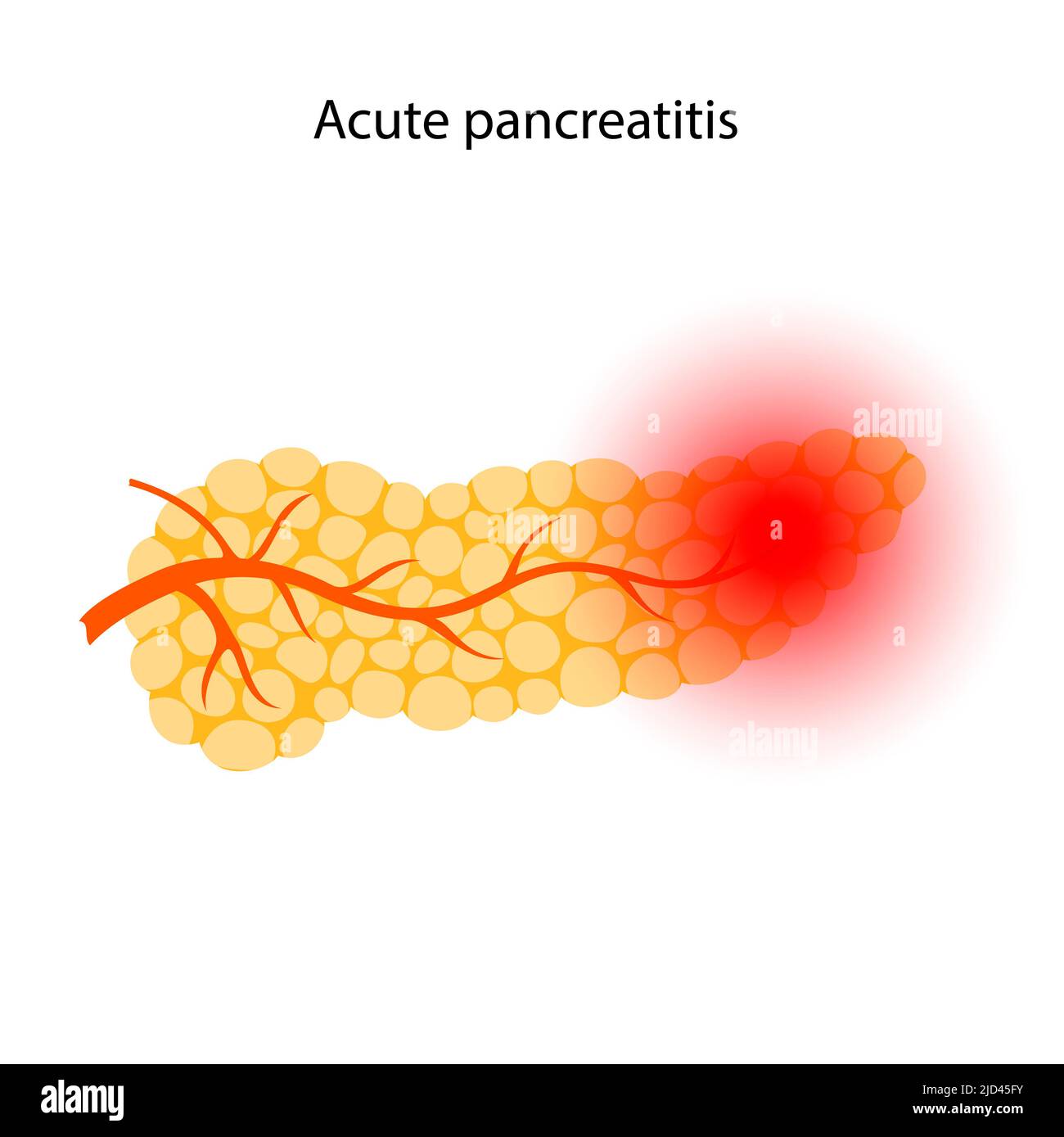 Acute pancreatitis, illustration Stock Photo - Alamy