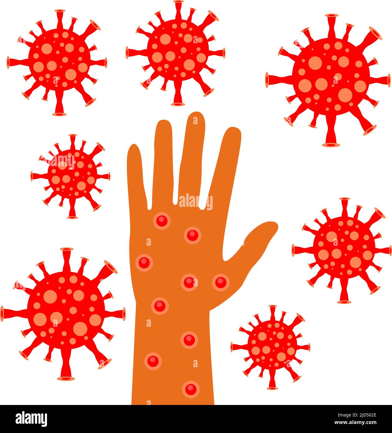 Monkeypox virus, hand in smallpox ulcers. Smallpox monkeys. Vector ...