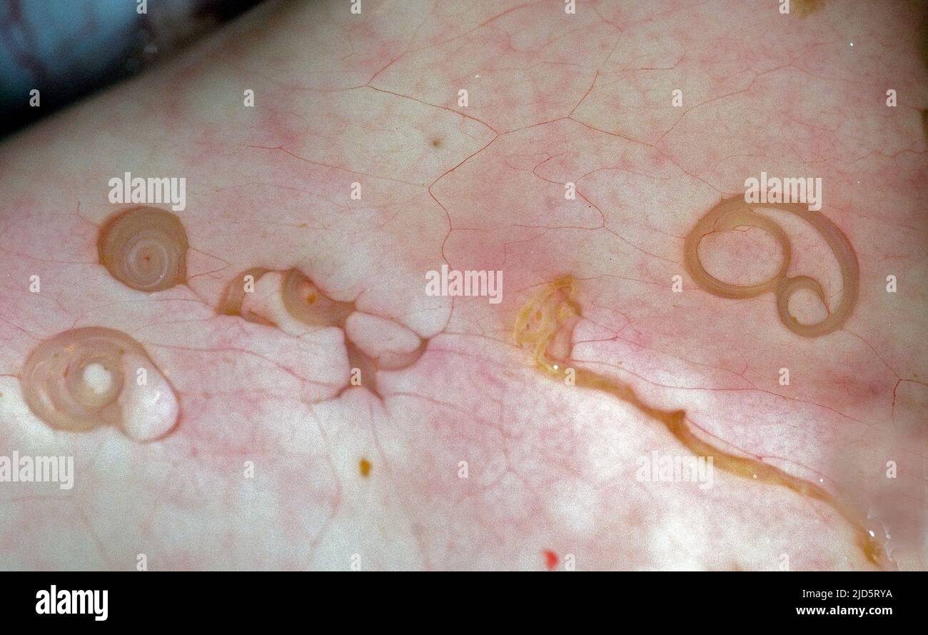 Anisakis hires stock photography and images Alamy