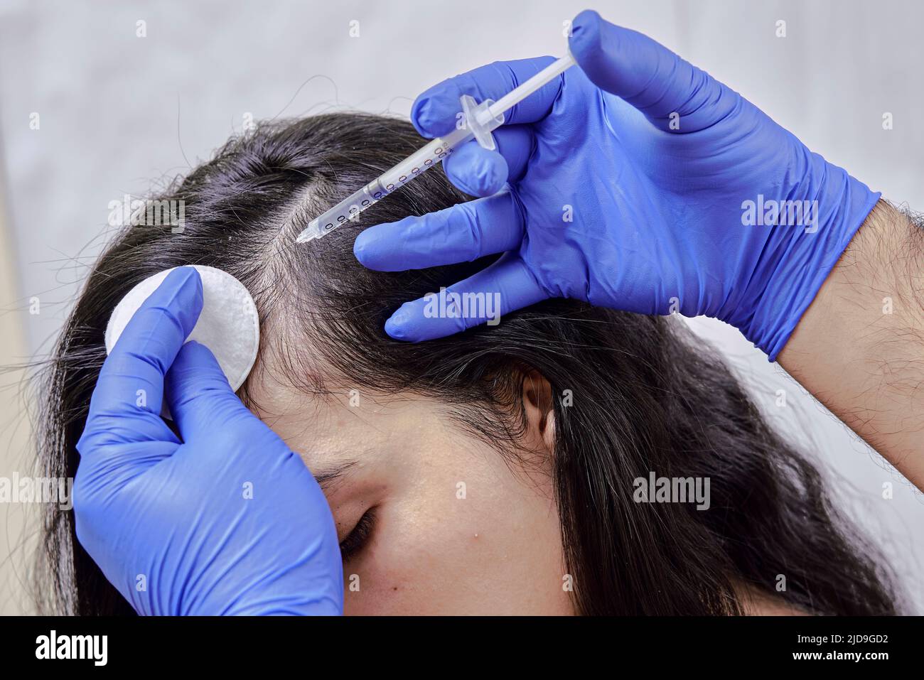 treatment of hair loss, injection for hair growth. Injected in woman's