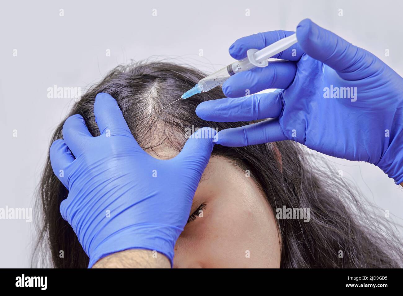 treatment of hair loss, injection for hair growth. Injected in woman's