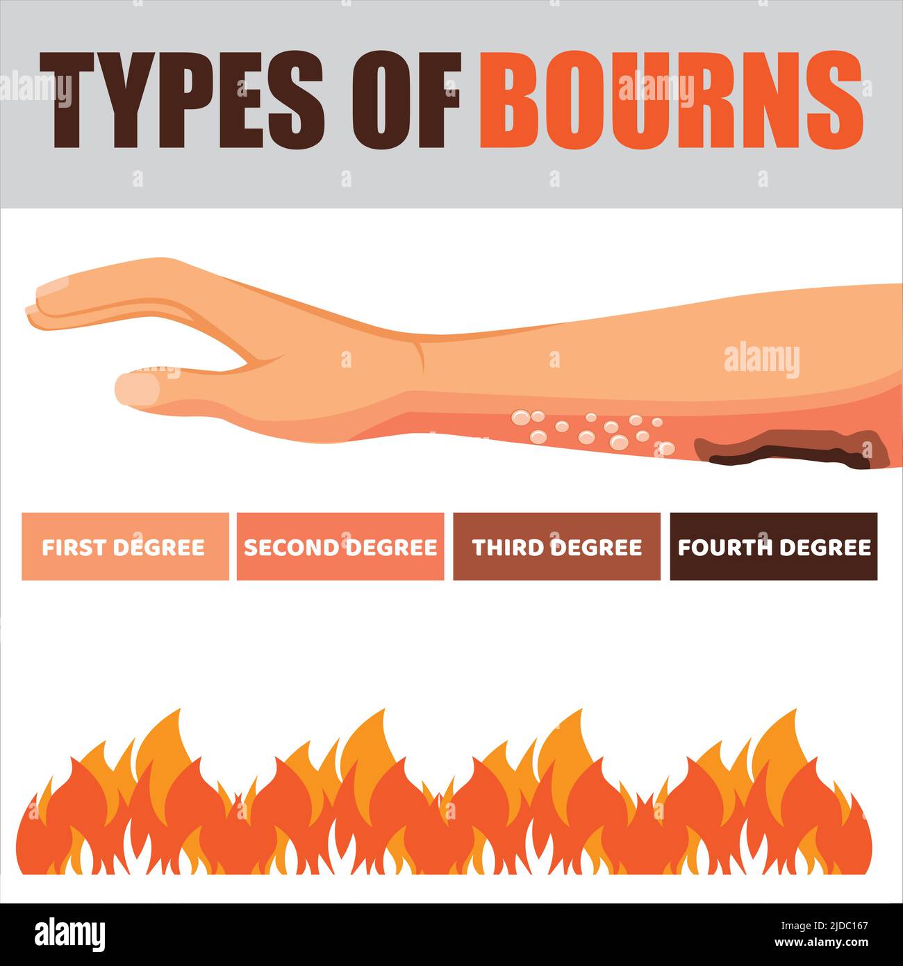 Burn injury treatment hi-res stock photography and images - Alamy Burn injury treatment hi-res stock photography and images - Alamy
