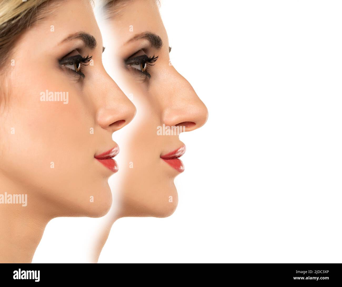 Young woman before and after plastic surgery of the nose on a white background. Stock Photo