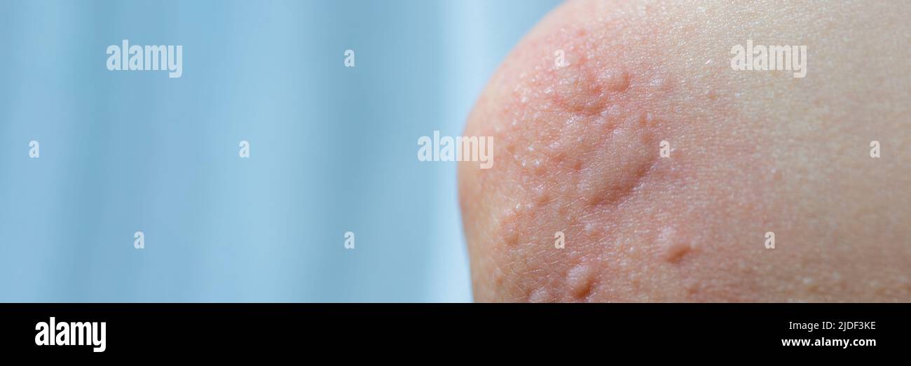 Urticaria on the skin. Red spots of an allergic reaction on the skin of
