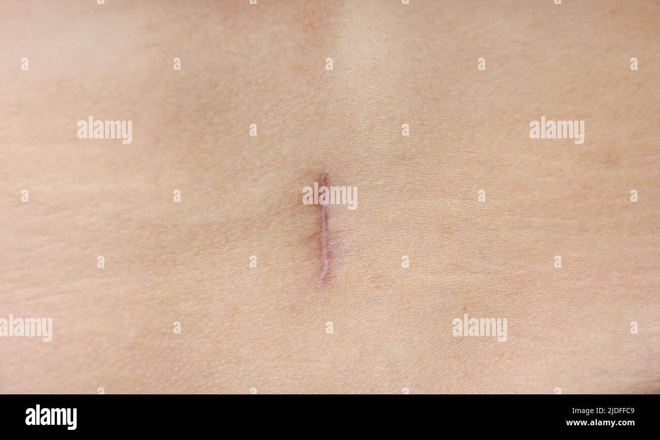 Appendix scar hi-res stock photography and images - Alamy