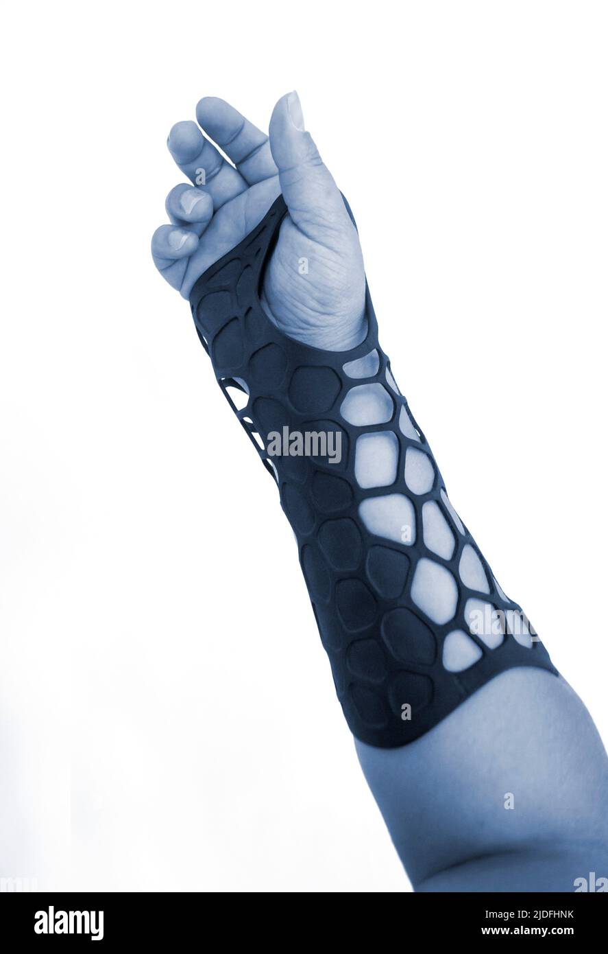 Orthopedic plastic prosthesis printed on powder 3D printer on hand