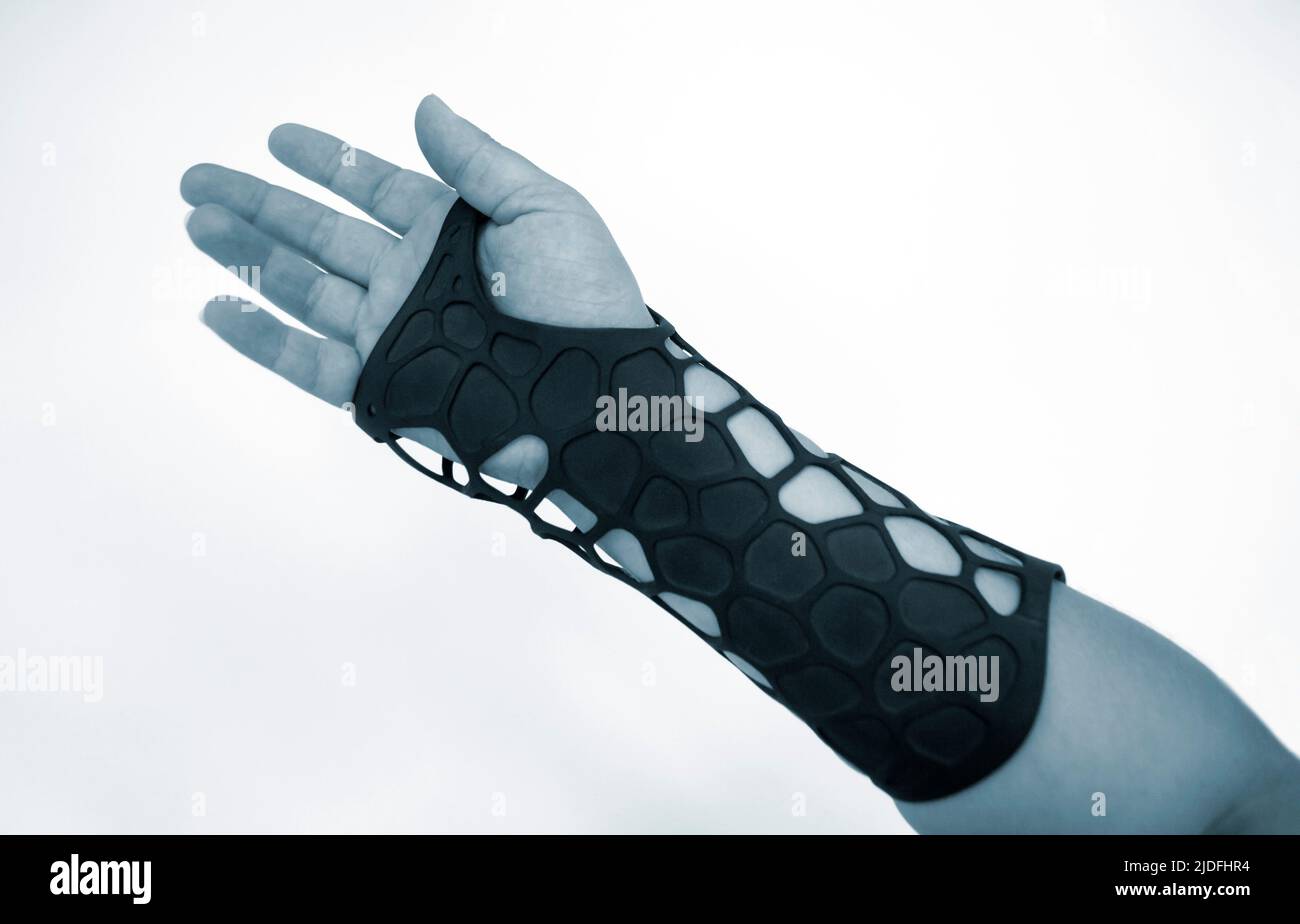 Orthopedic plastic prosthesis printed on powder 3D printer on hand