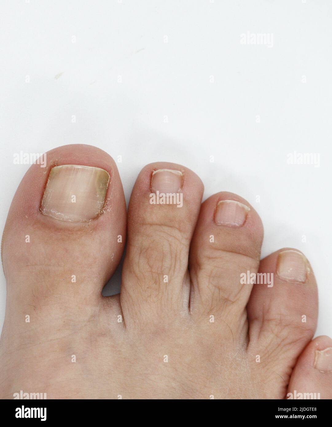 How Is Urea Used To Treat Fungal Infections Of The Toe And