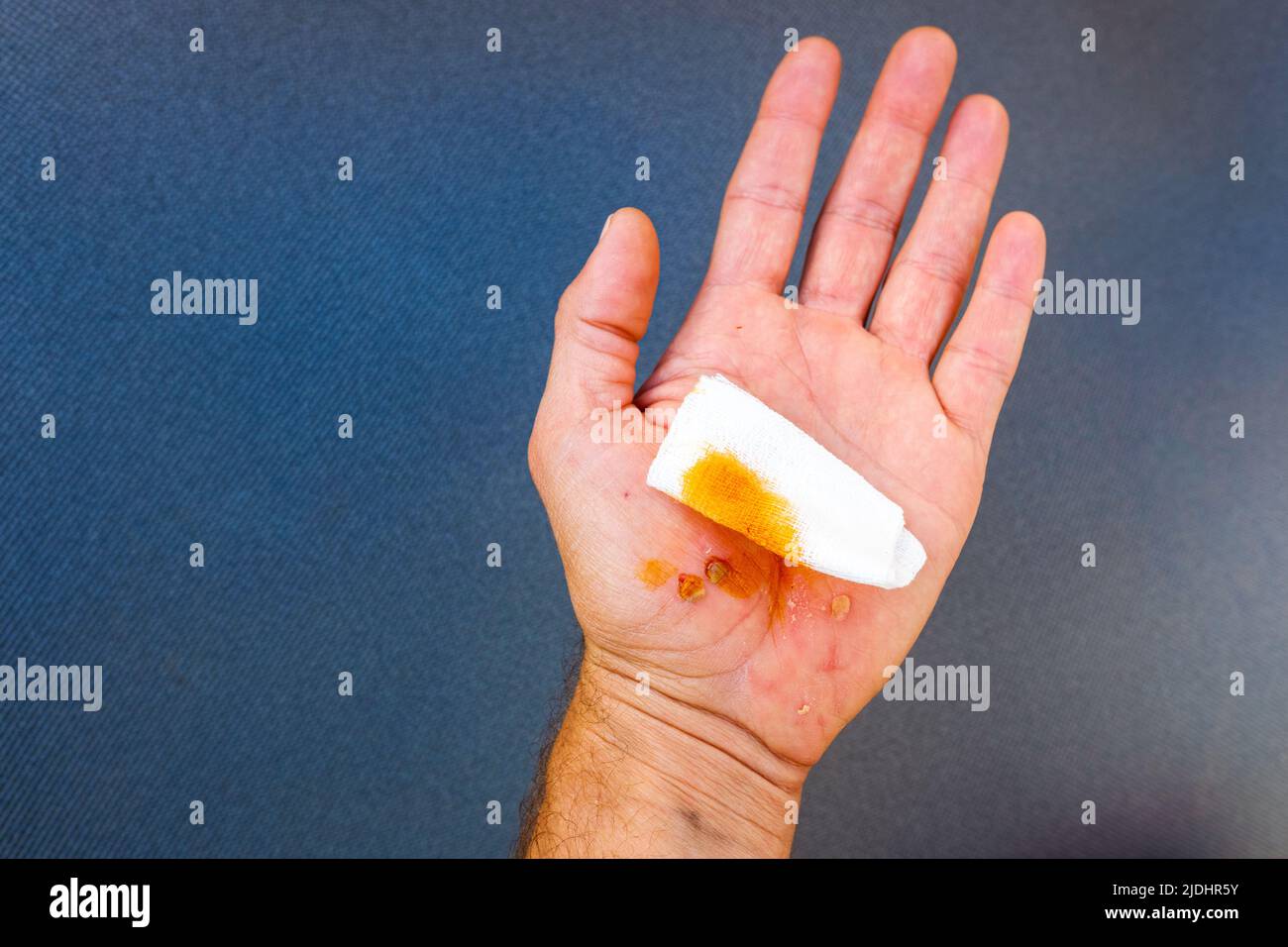 Injured palm with wounds and scratches, disinfected with iodine to prevent infection. Stock Photo