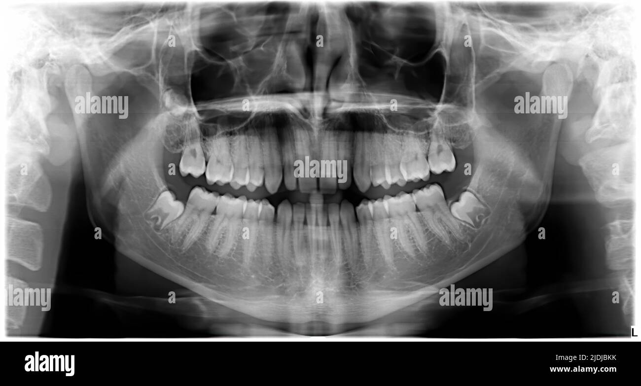 Pantography of the perfect teeth of a healthy young man. X-ray of a human mouth Stock Photo