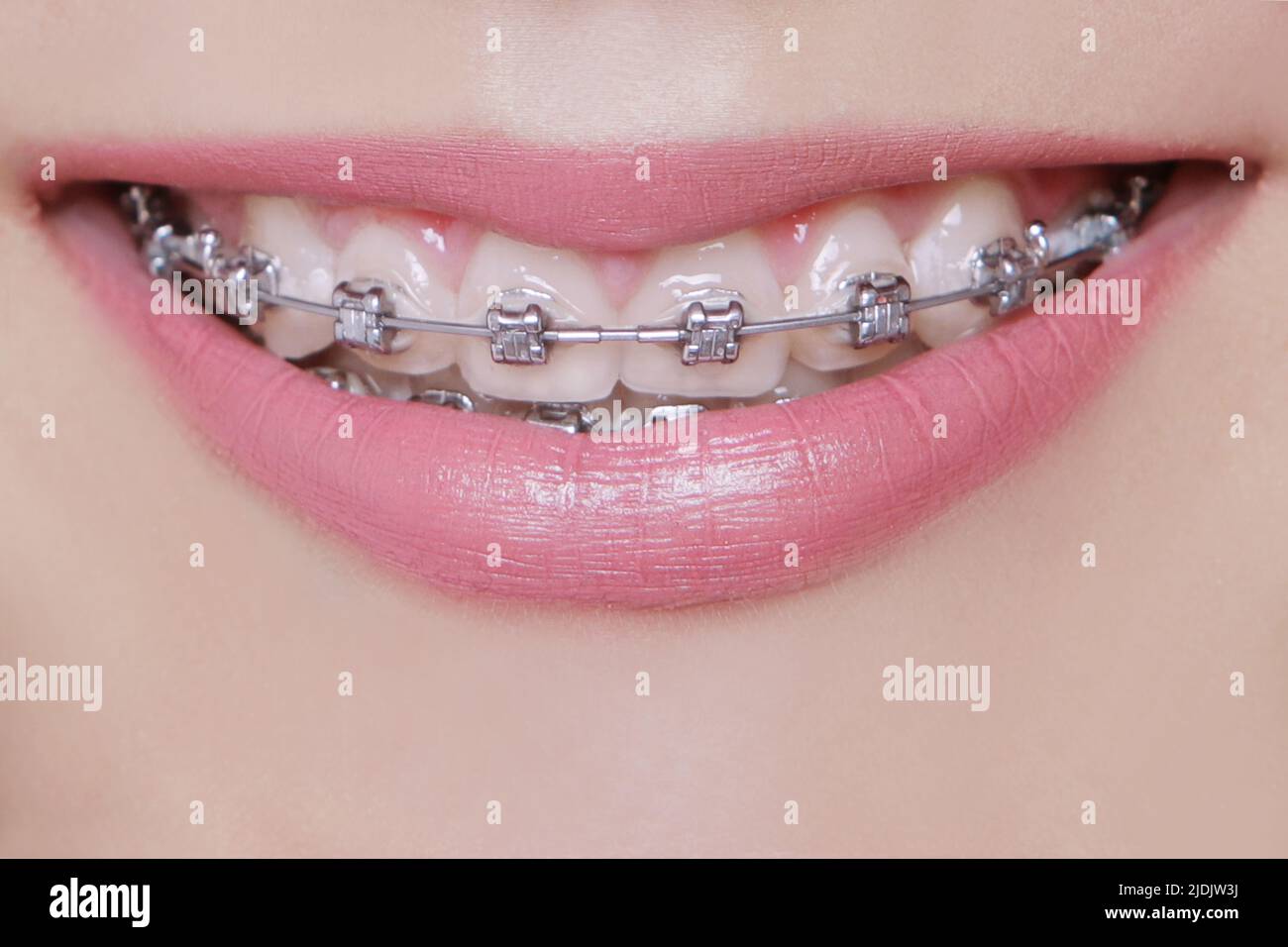 metal braces on young girl's teeth Stock Photo Alamy