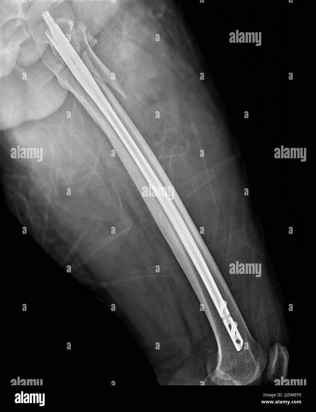 X-ray femur bone Fracture After Total Hip and femur Replacement. Stock Photo