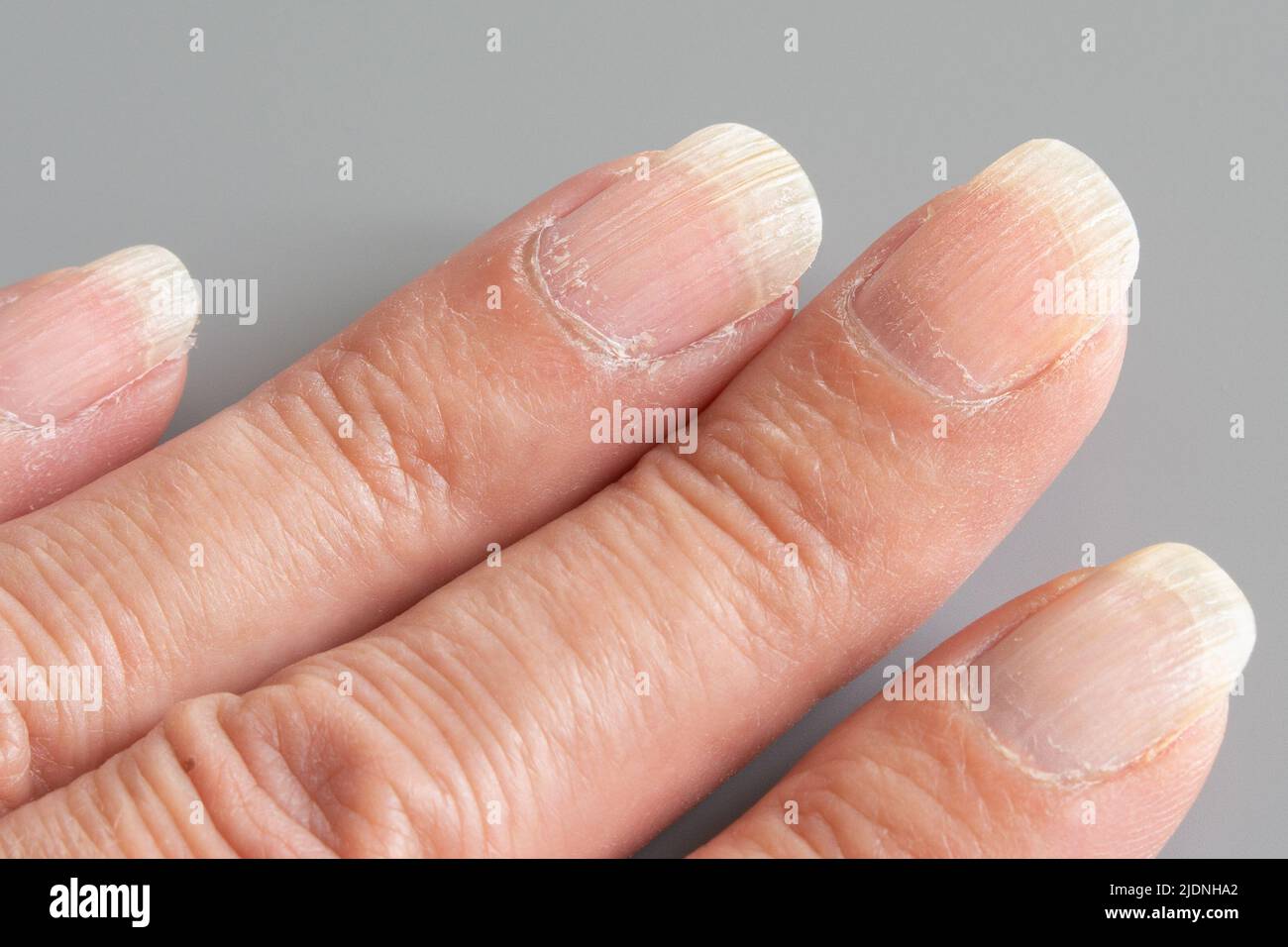 Ridged, damaged, dried out nails. Woman's hand closeup Stock Photo Alamy