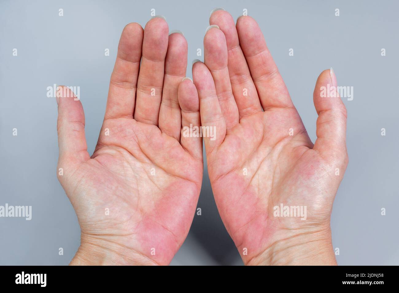 Bilateral Palmar Erythema Pe Red Hands Palm Stock Photo Alamy