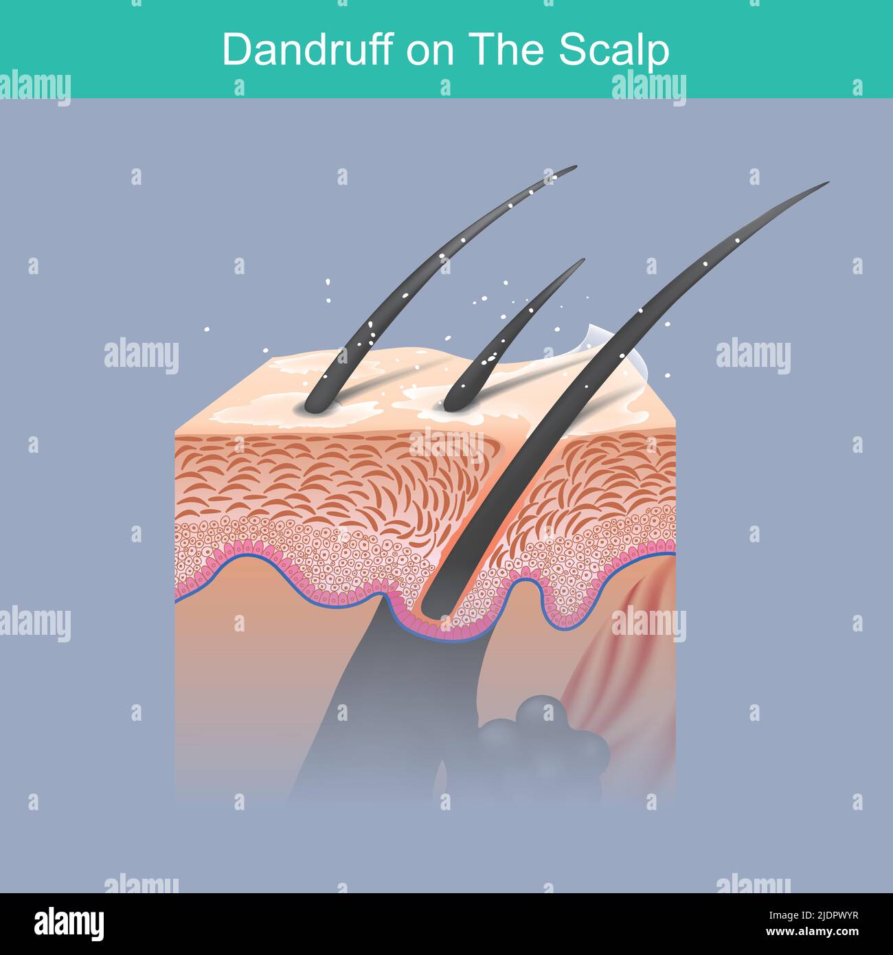 Dandruff on the scalp. Hair illustration for a problem dandruff on the