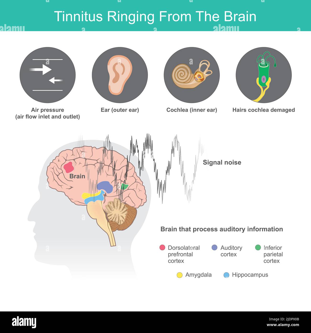 Tinnitus Ringing From The Brain, Is the term for a buzzing noise in your ears from symptoms abnormal in ears or the brain. Stock Vector