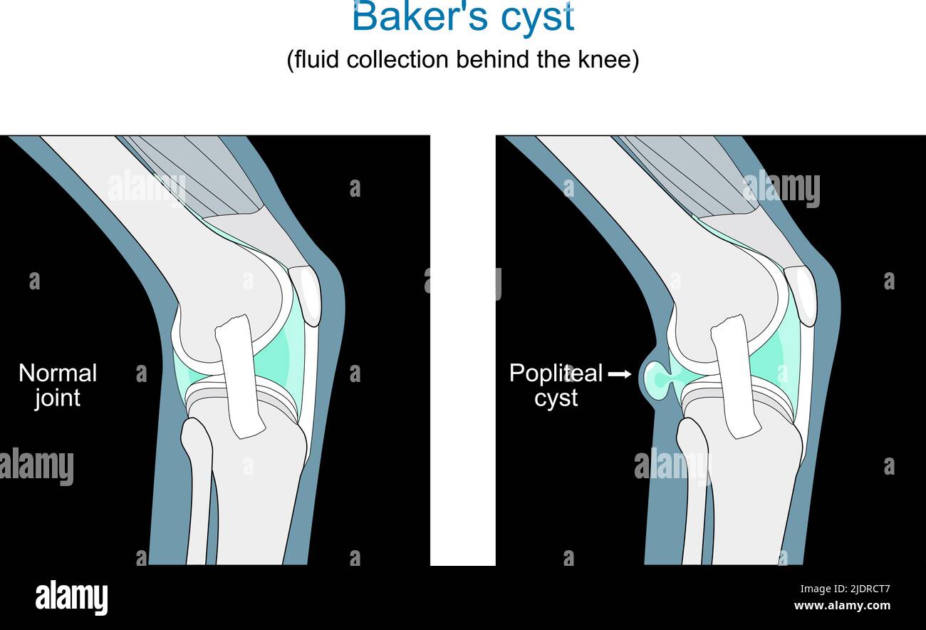 Baker's cyst. fluid collection behind the knee. cross section of Human joint. Flat vector