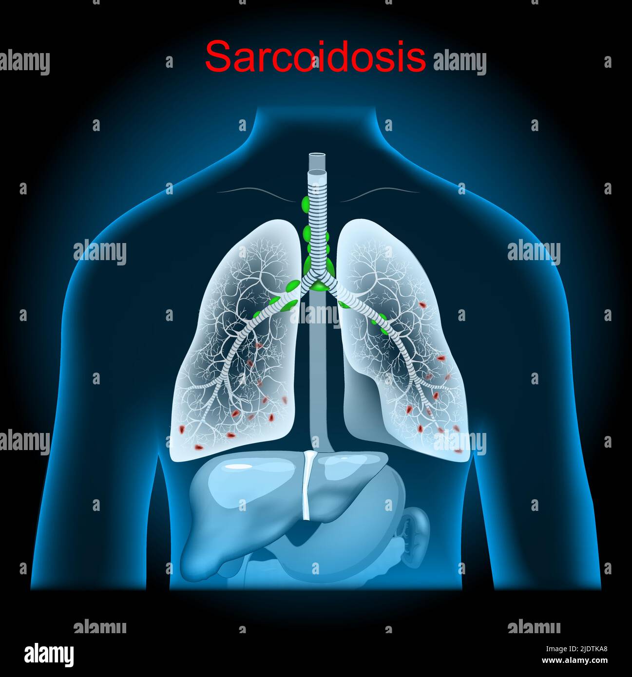 Sarcoidosis. Enlarged lymph nodes. Lungs with granulomas, stomach and liver into x-ray blue realistic torso. Human silhouette on dark background Stock Vector