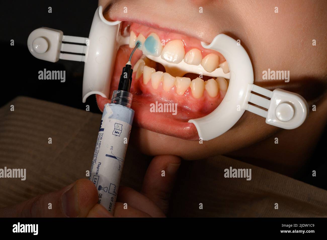 Ivano-Frankivsk, Ukraine February 3, 2022: applying glue to teeth to stick  braces, align teeth with braces, basis for braces Stock Photo - Alamy