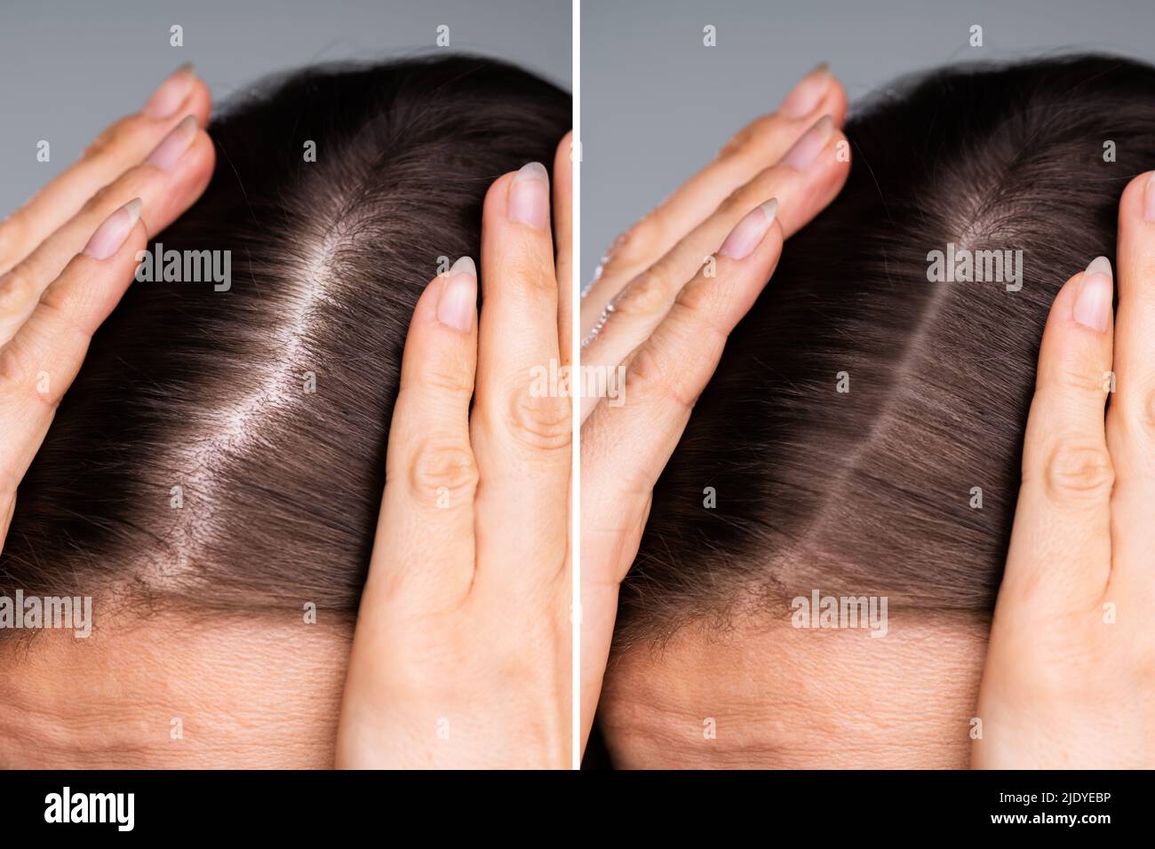 Woman Before And After Hair Loss Treatment Stock Photo
