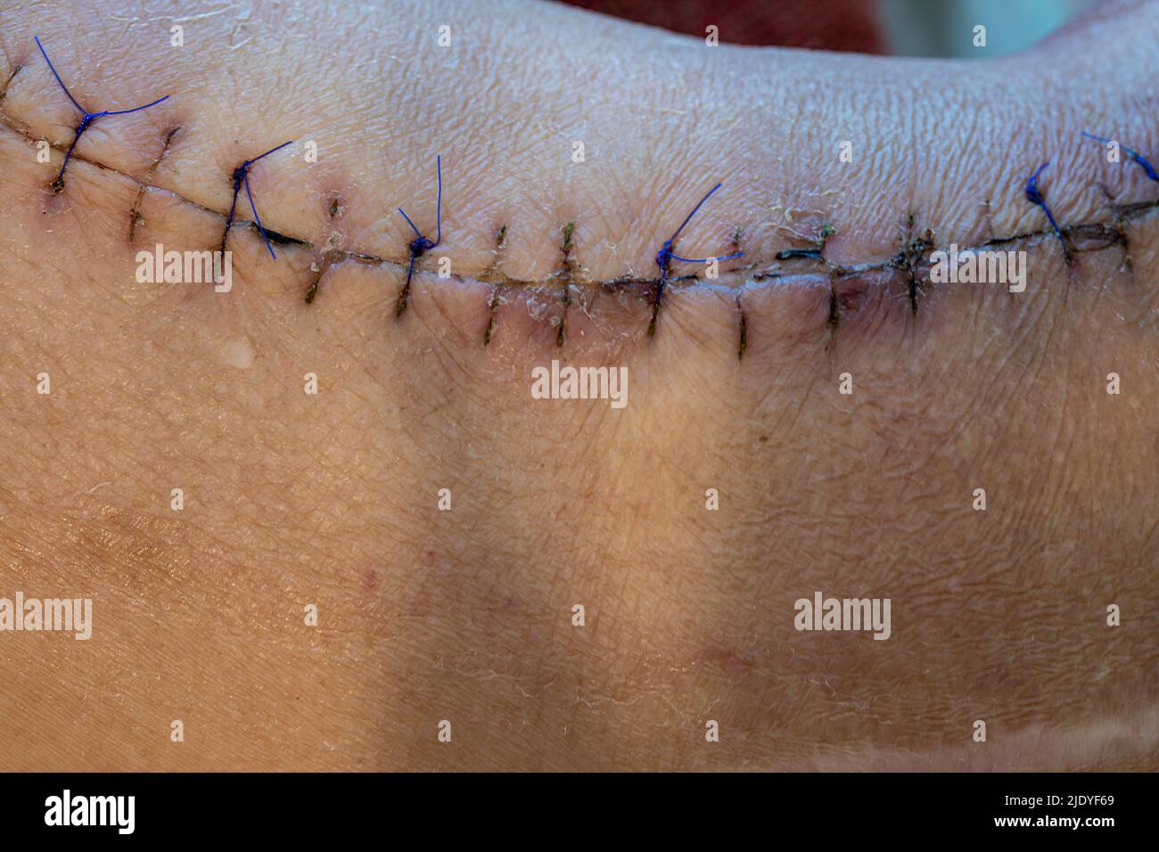 Close-up picture of a scar with stitch Stock Photo