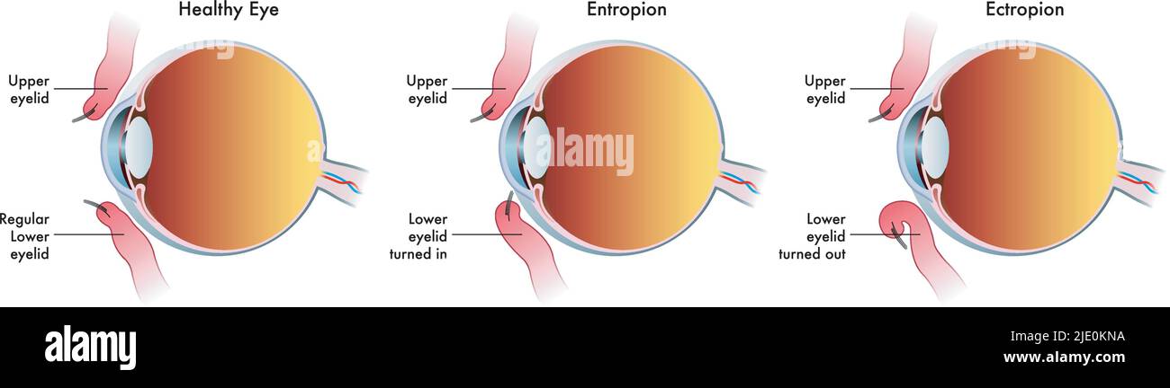 Medical illustration shows the comparison between a normal eye, one affected by entropion and another affected by ectropion. Stock Vector