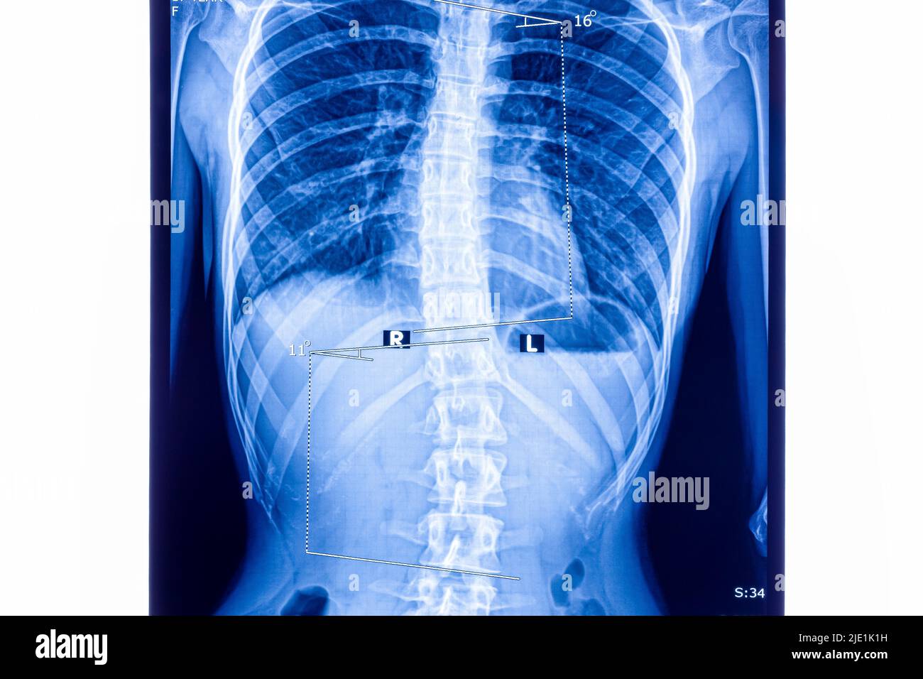X ray showing scoliosis of the lumbar spine. Scoliosis is an abnormal lateral curvature of the spine. Zoom in. Stock Photo