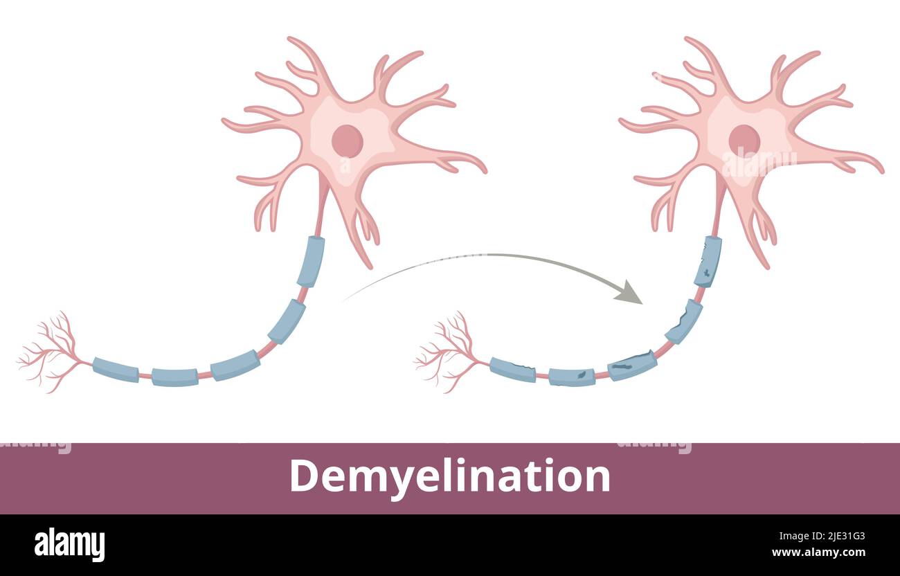 Demyelination process. Protective covering (myelin sheath) that surrounds nerve fibers is damaged due to diseases like multiple sclerosis Stock Vector