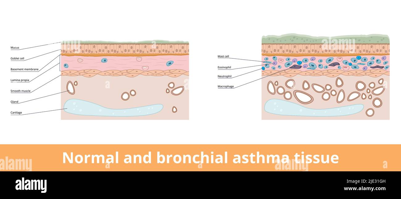 Normal and bronchial asthma tissue. Visualization of difference between normal and bronchial asthma tissues, including goblet cells and smooth muscle. Stock Vector