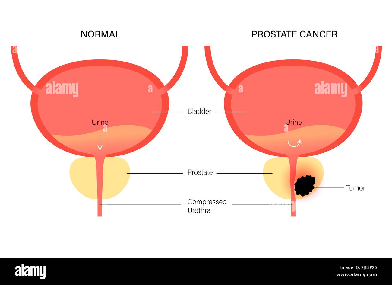 Prostate cancer, illustration. Stock Photo