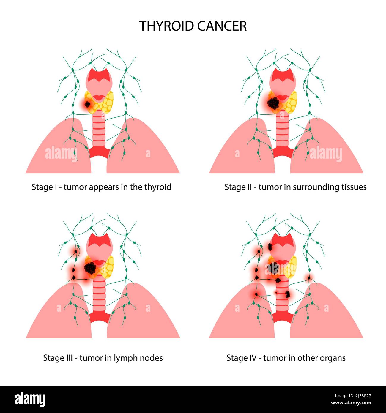 Thyroid cancer stages, illustration. Stock Photo