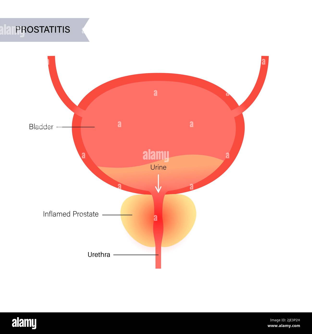 Prostatitis, illustration. Stock Photo