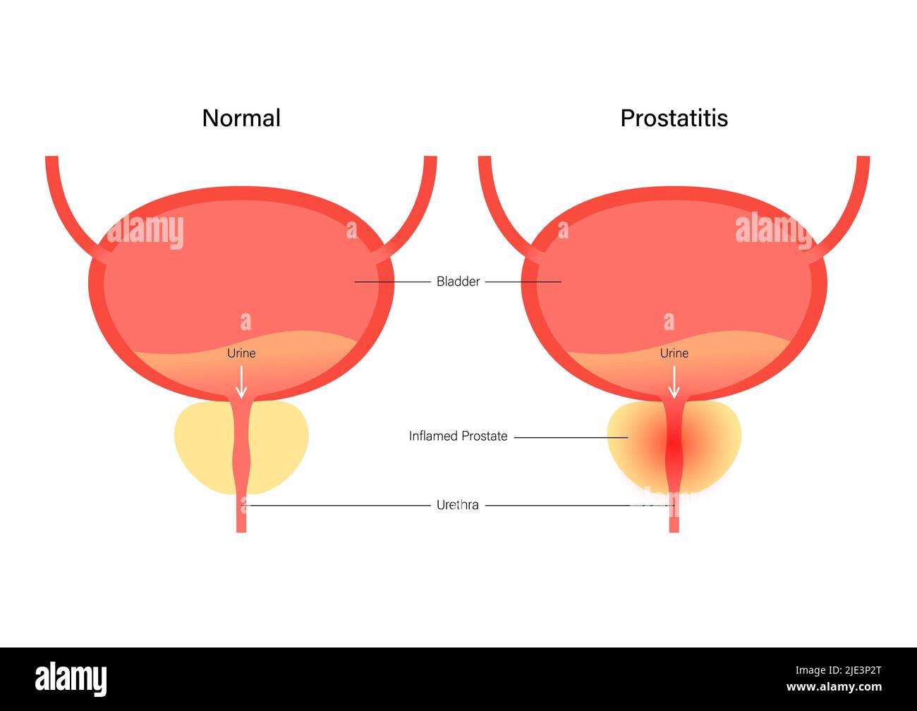 Prostatitis, illustration. Stock Photo