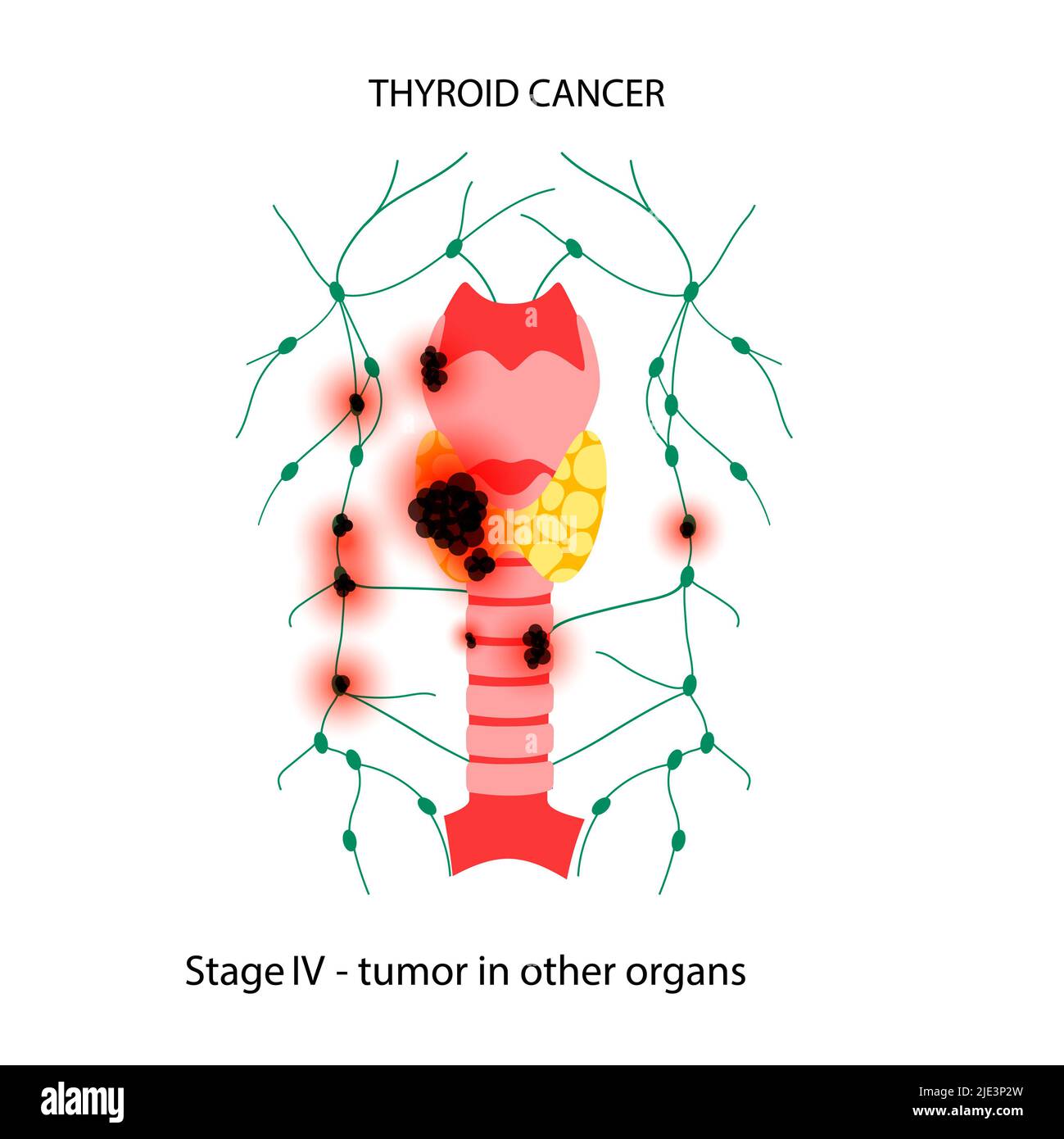 Thyroid cancer, illustration. Stock Photo