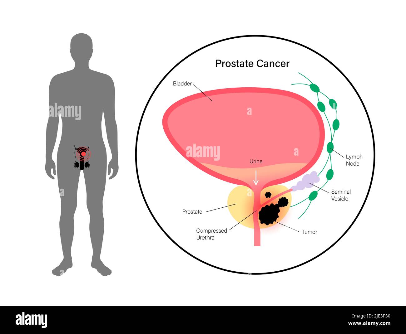 Prostate cancer, illustration. Stock Photo