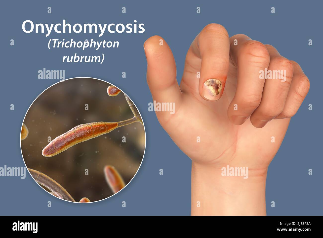 Illustration of a fungal nail infection showing human hand with onychomycosis and close-up view of Trichopyton rubrum fungi, one of the causative agen Stock Photo