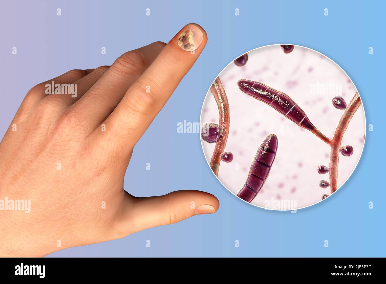 Illustration of a fungal nail infection showing human hand with onychomycosis and close-up view of Trichopyton rubrum fungi, one of the causative agen Stock Photo