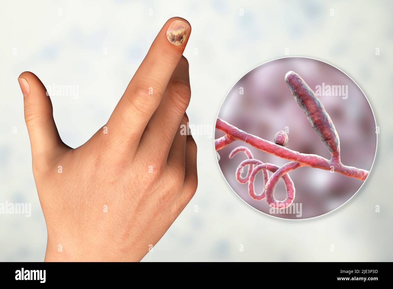 Nail Fungus Infection on the Big Finger. Fungal Infection on Nails Hand,  Finger with Onychomycosis Stock Image - Image of close, human: 123697079