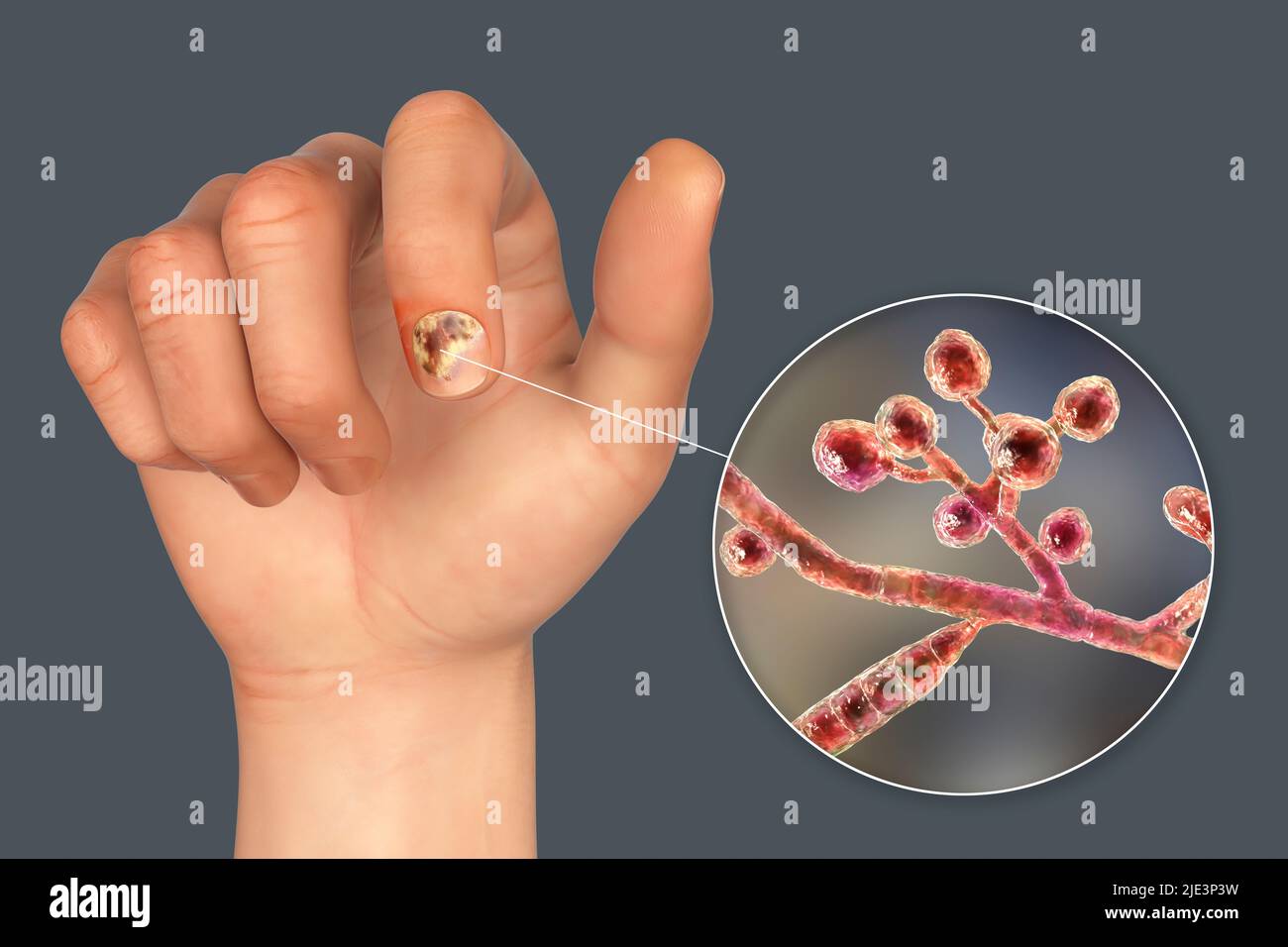 Illustration of a fungal nail infection showing human hand with onychomycosis and close-up view of Trichopyton mentagrophytes fungi, one of the causat Stock Photo