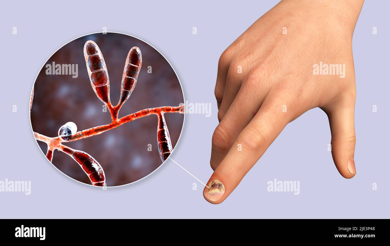 Illustration of a fungal nail infection showing human hand with onychomycosis and close-up view of Epidermophyton floccosum fungi, one of the causative agents of nail infections. Stock Photo