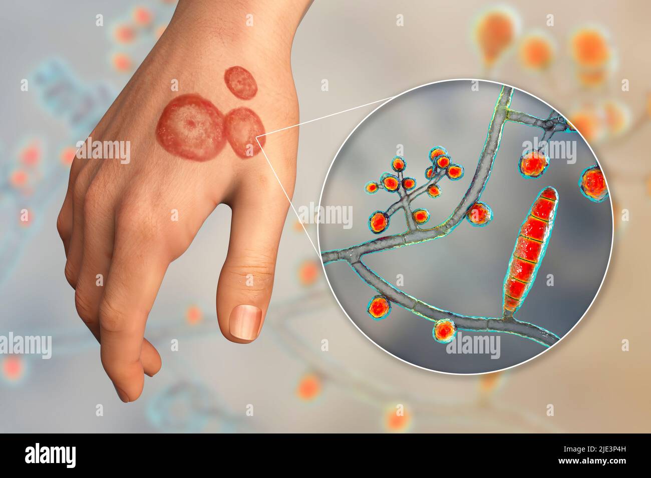 Fungal infection on a man's hand, illustration. Known as ringworm  infection, or tinea manuum. It can be caused by various fungi, including  Trichophyton mentagrophytes. It causes severe itching. The disease is highly