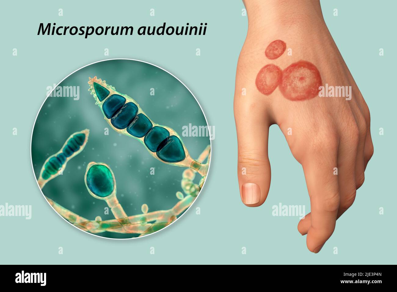Fungal infection on a man's hand, illustration. Known as ringworm infection, or tinea manuum. It can be caused by various fungi, including Microsporum audouinii. It causes severe itching. The disease is highly contagious, and can be spread by direct contact or by contact with contaminated material. Treatment is with antifungal drugs. Stock Photo