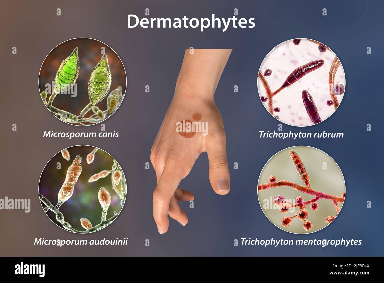 Fungal infection on a man's hand. Tinea manuum and close-up view of  dermatophyte fungi, 3D illustration Stock Illustration
