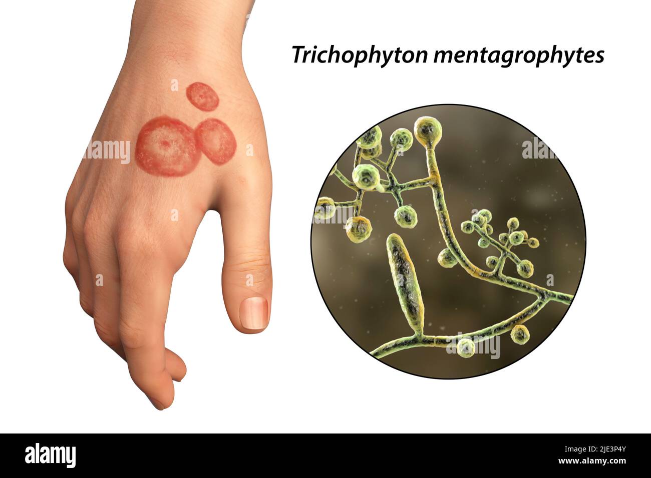 Fungal infection on a man's hand, illustration. Known as ringworm infection, or tinea manuum. It can be caused by various fungi, including Trichophyton mentagrophytes. It causes severe itching. The disease is highly contagious, and can be spread by direct contact or by contact with contaminated material. Treatment is with antifungal drugs. Stock Photo