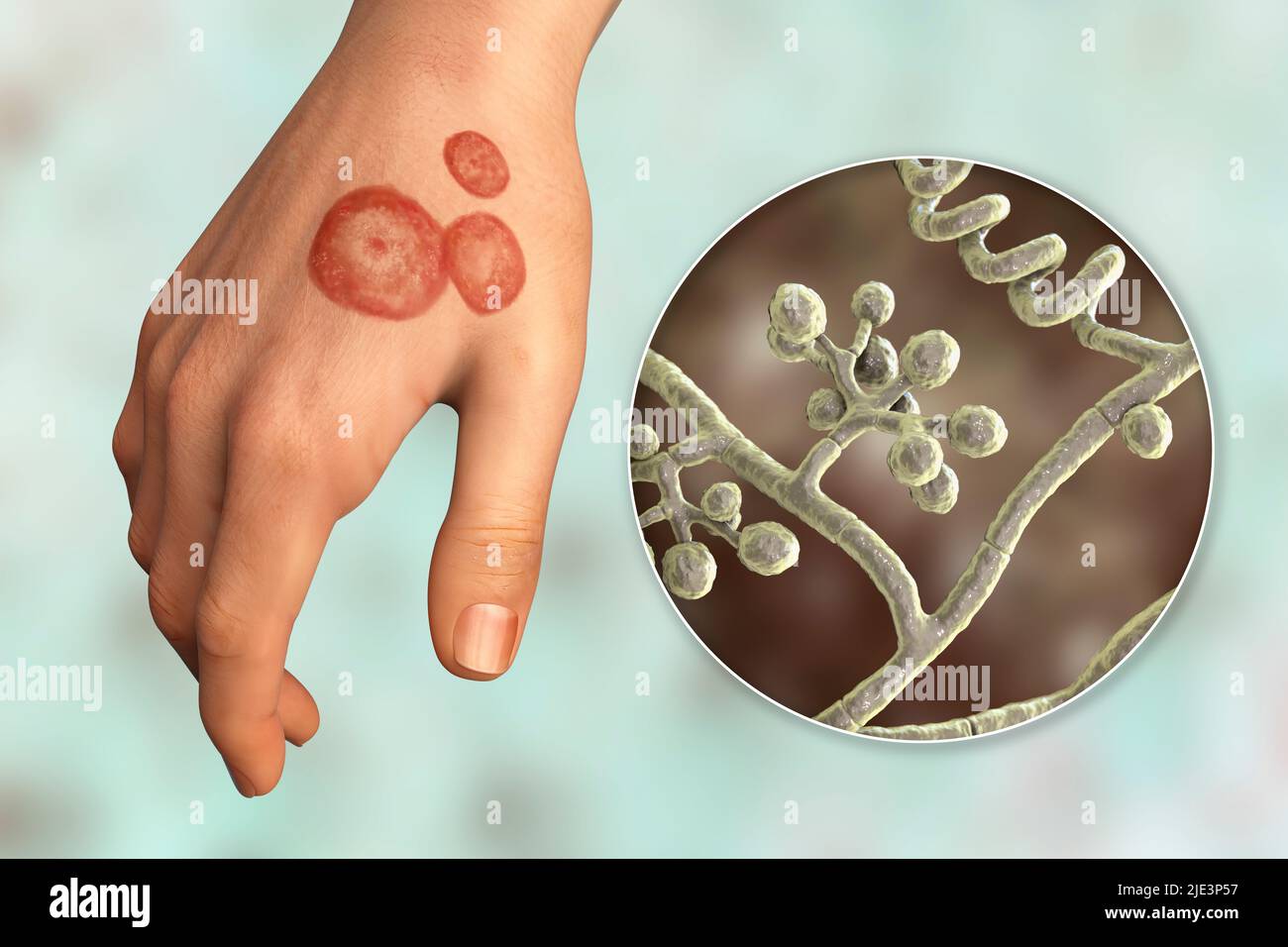 Fungal infection on a man's hand, illustration. Known as ringworm infection, or tinea manuum. It can be caused by various fungi, including Trichophyto Stock Photo